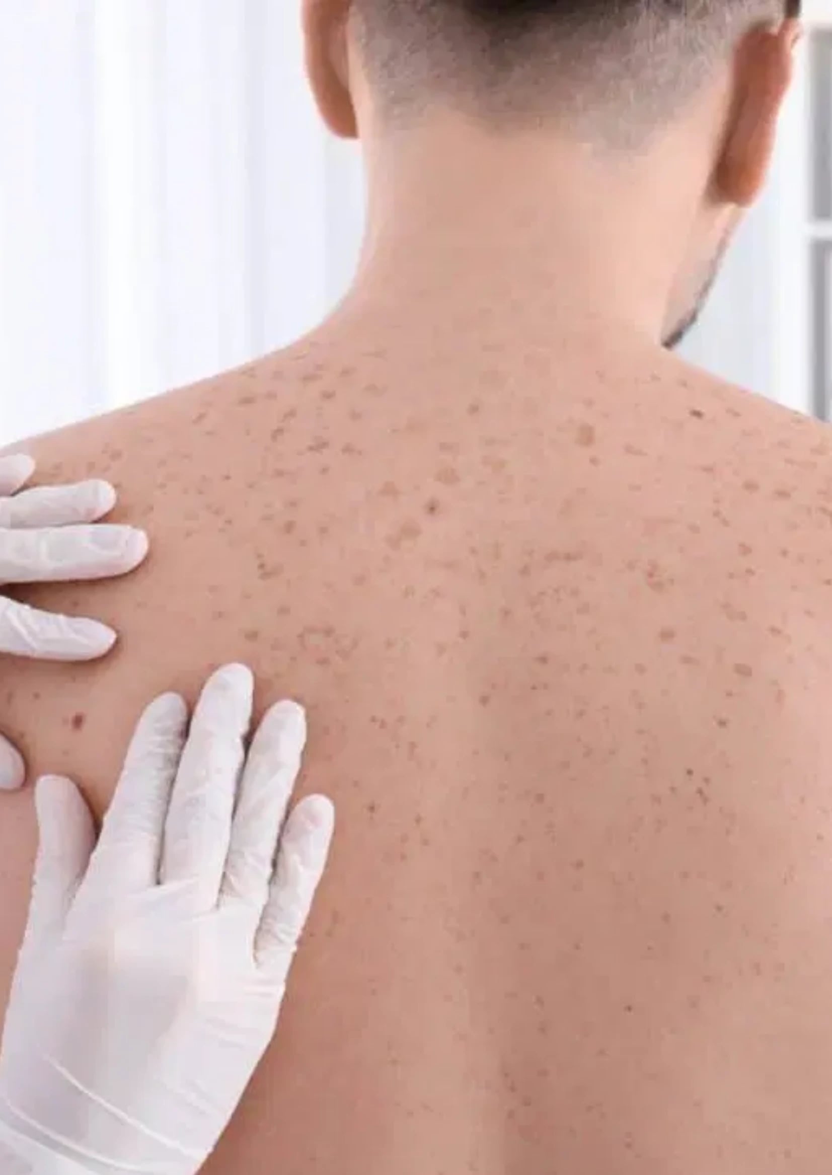 Common Signs or Symptoms of Skin Cancer