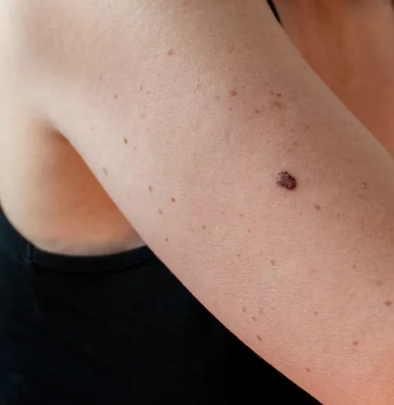 Skin Cancer Treatment